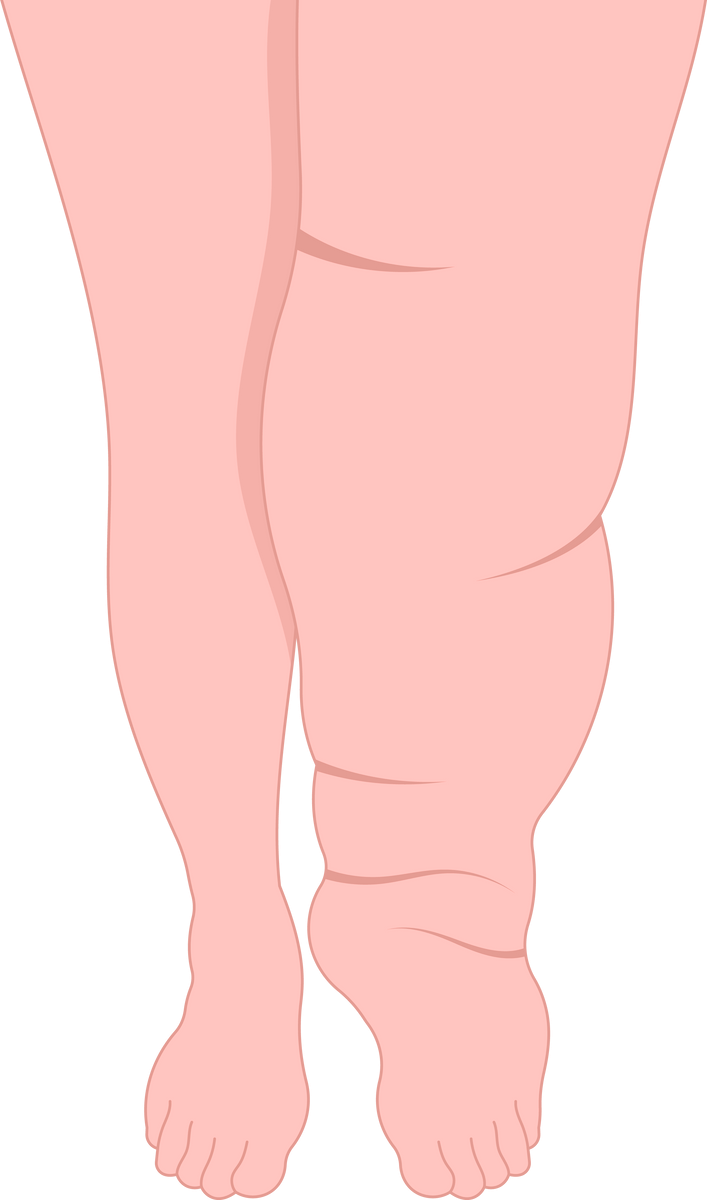 Lymphedema
